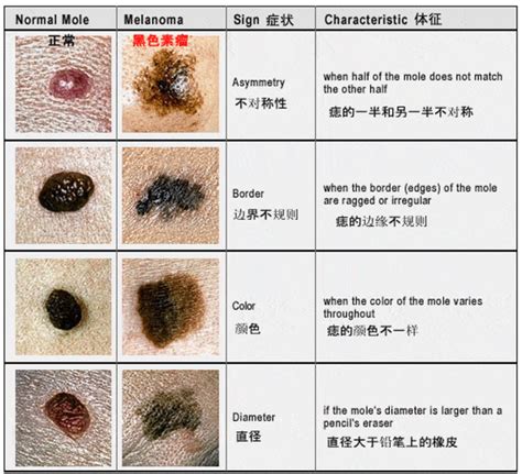 嘴唇突然长痣|痣也可能会癌变！长在 3 个地方要注意